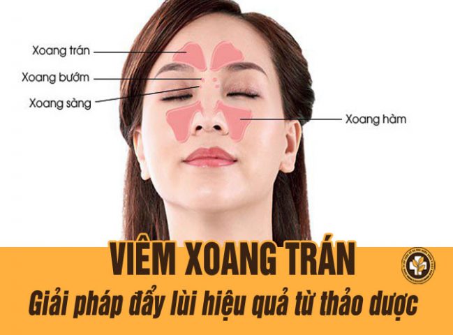 Viêm xoang trán