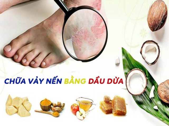 Chữa vảy nến bằng dầu dừa