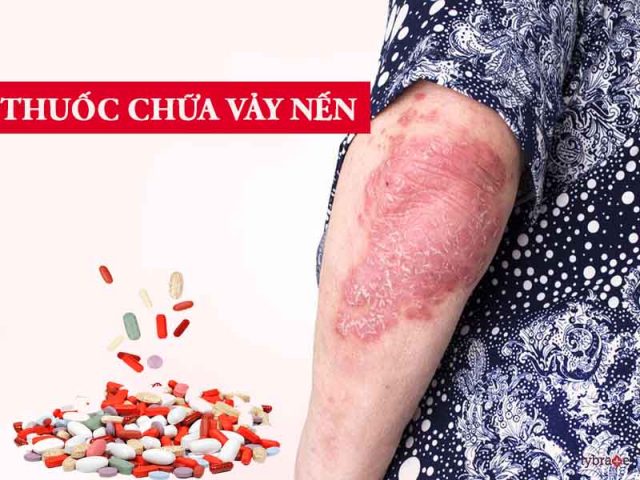 Thuốc trị vảy nến