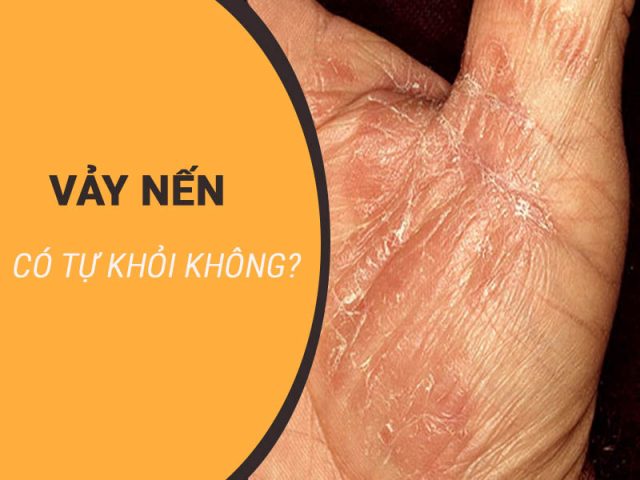 Bệnh vảy nến có tự khỏi không