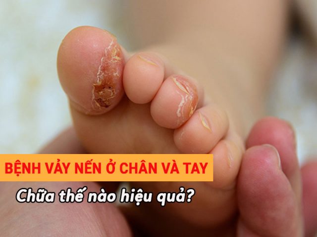 vảy nến ở chân và tay