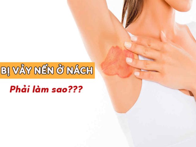 Vảy nến ở nách