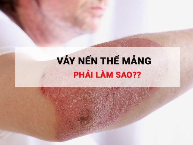 Vảy nến thể mảng