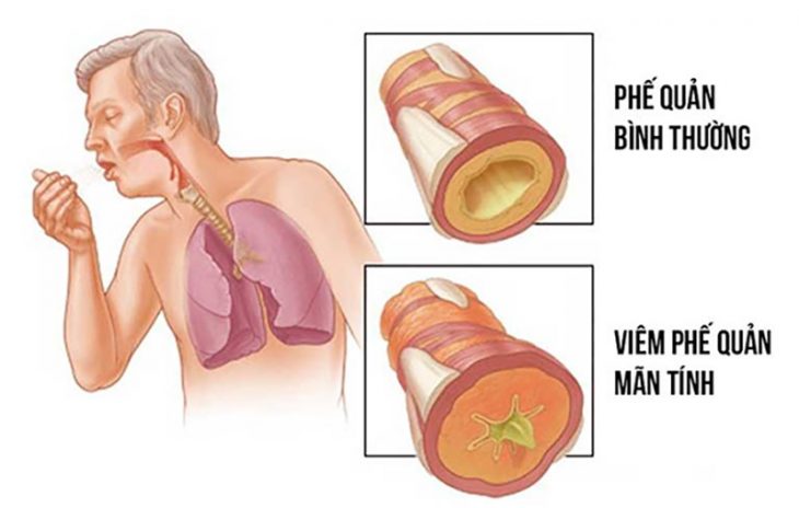 Viêm phế quản mãn tính gây co thắt phế quản do tăng tiết dịch nhầy