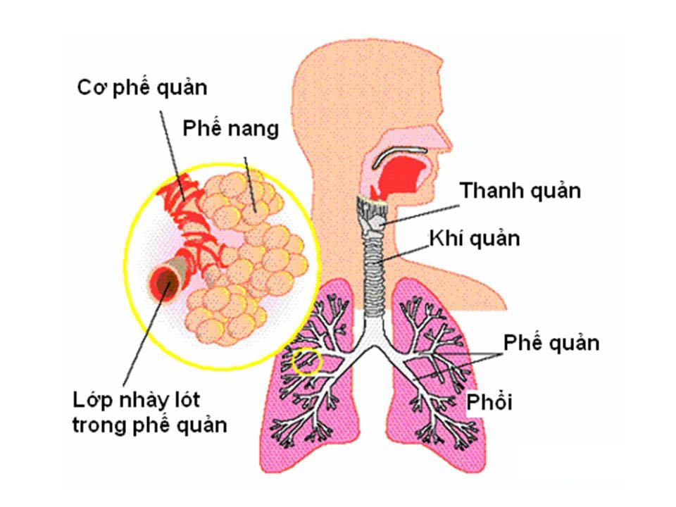 Viêm phế quản phổi là tình trạng viêm nhiễm xảy ra ở cả phế quản và phế nang trong phổi