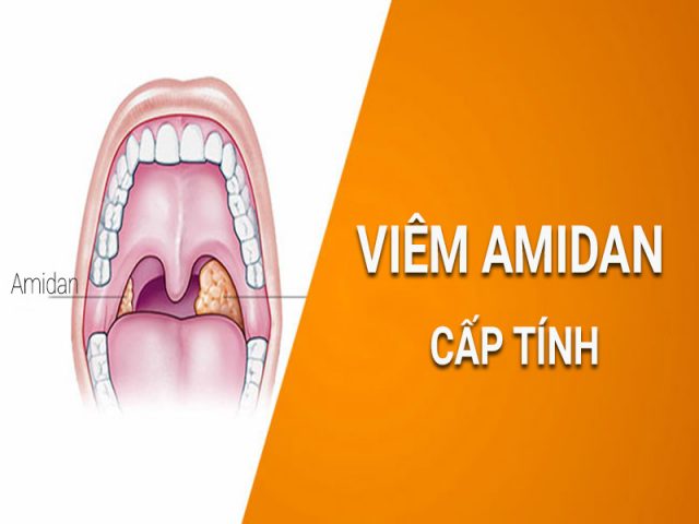 viêm amidan cấp tính