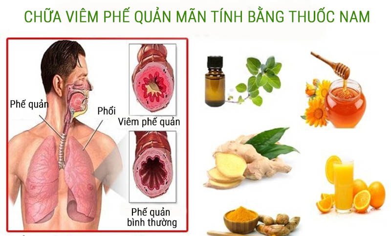 Phương pháp chữa viêm phế quản bằng thuốc nam có nhiều ưu điểm phù hợp với bệnh nhân mãn tính