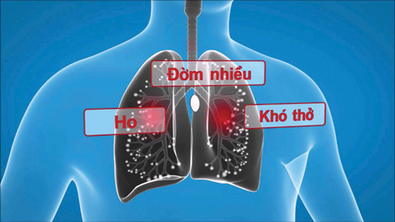 Một số triệu chứng điển hình giúp chẩn đoán viêm phế quản mãn tính ở người lớn