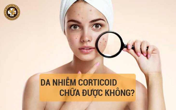 Da nhiễm corticoid có chữa được không