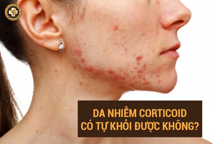 da nhiễm corticoid có tự khỏi không