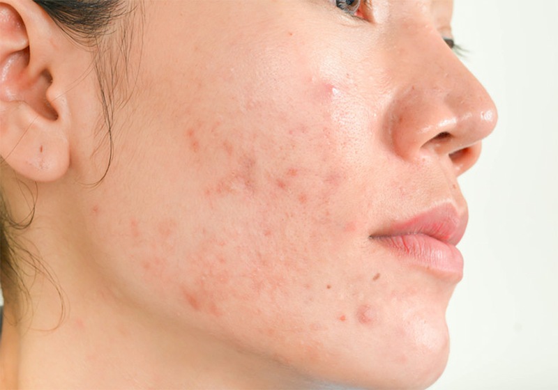 Triệu chứng dị ứng có thể tự khỏi ở trường hợp nhẹ 