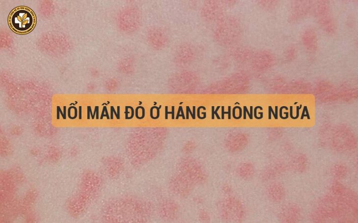 Nổi mẩn đỏ ở háng không ngứa là bệnh gì