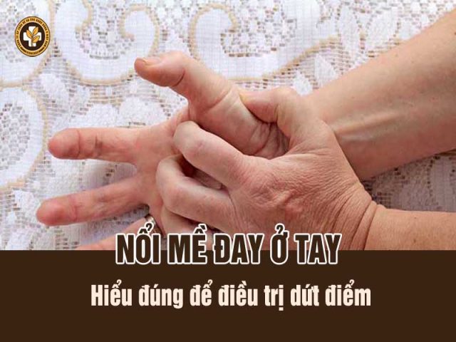 Nổi mề đay ở tay