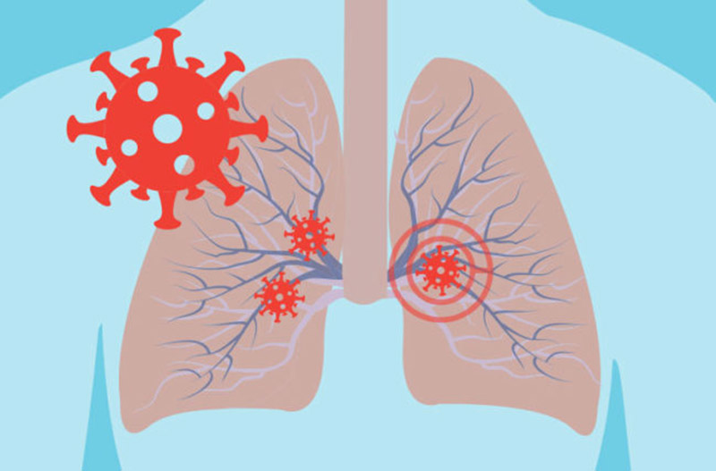 Virus và vi khuẩn là nguyên nhân chính gây viêm phế quản phổi ở trẻ