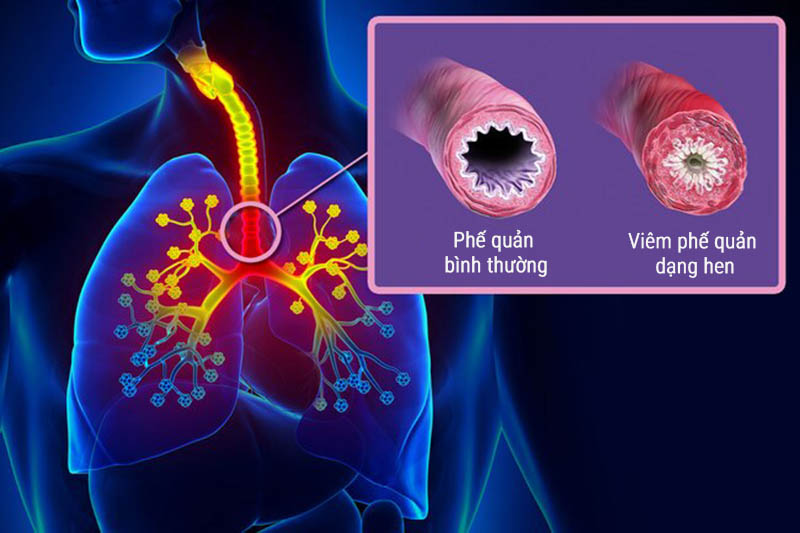 Viêm phế quản dạng hen làm bít tắc đường thở, gây khó thở nặng