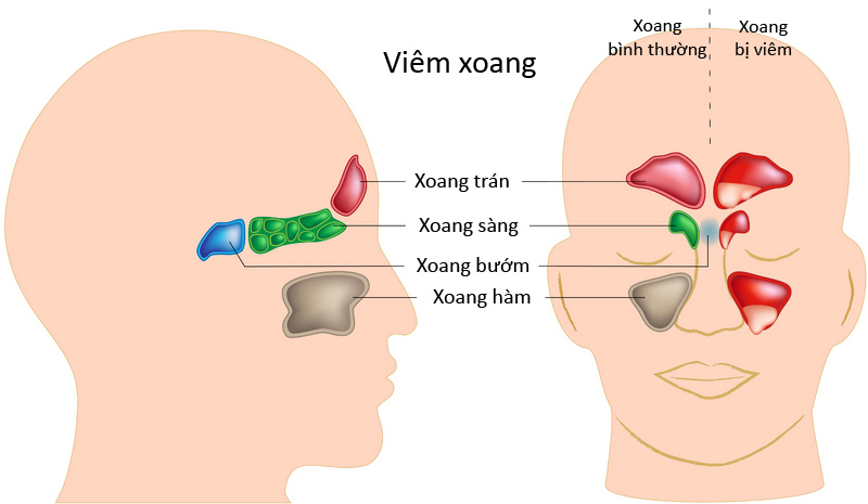 Viêm xoang sàng và xoang bướm sẽ gây ho nhiều