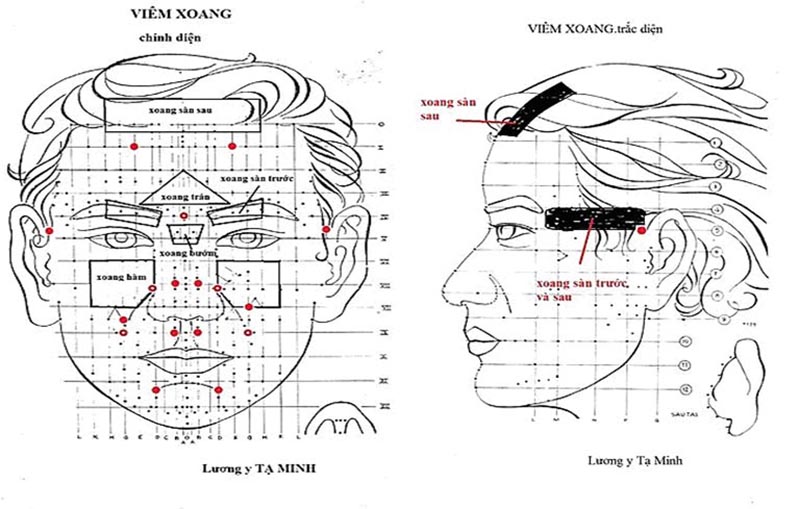 Vị trí các huyệt viêm xoang trong diện chẩn