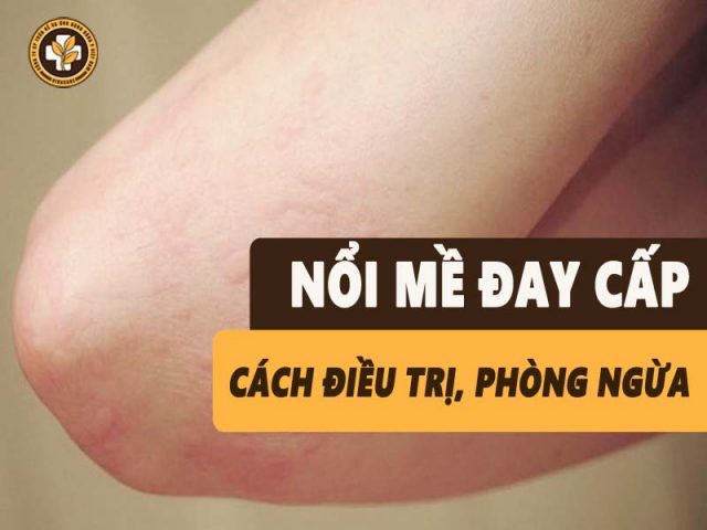 Mề đay cấp