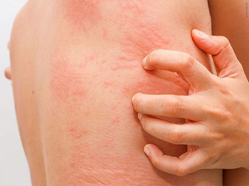 Mề đay mãn tính gây ngứa ngáy đỏ rát da