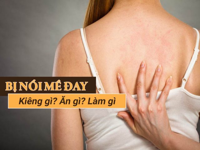 Bị nổi mề đay kiêng gì? Nên làm gì? Ăn gì để nhanh khỏi [LỜI KHUYÊN CHUYÊN GIA]