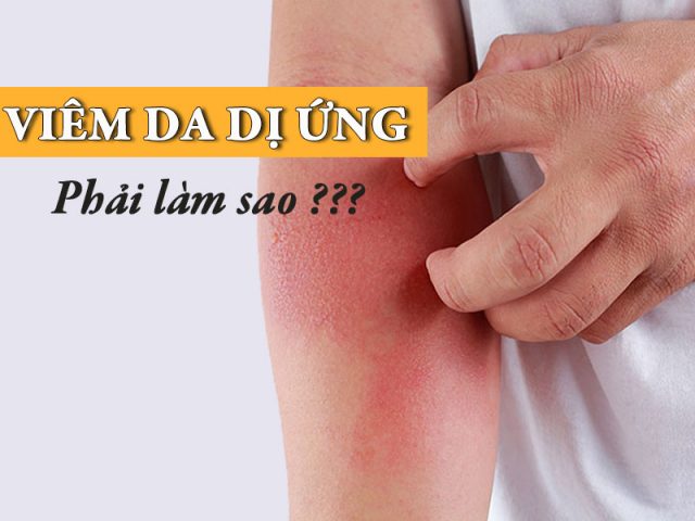 Viêm da dị ứng là bệnh gì? Gồm những loại nào? Có nguy hiểm không? Điều trị bằng cách nào?