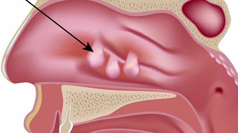 Viêm xoang có polyp mũi là tình trạng thoái hóa mô mềm tại niêm mạc mũi