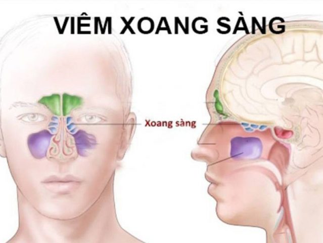 Viêm xoang sàng sau có chữa được không