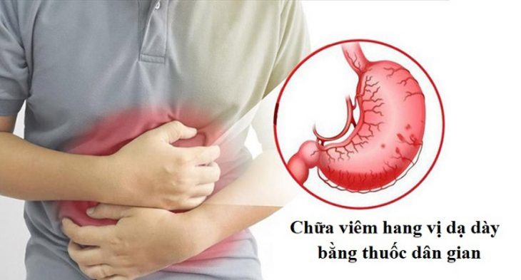 Bài thuốc dân gian chữa viêm hang vị dạ dày