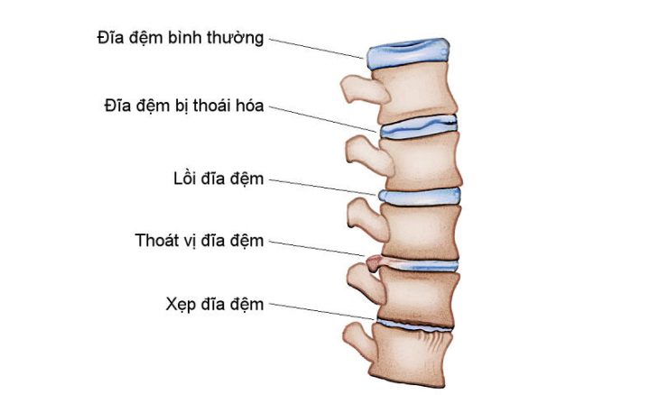 Lồi đĩa đệm là tình trạng bao xơ đĩa đệm bị tổn thương