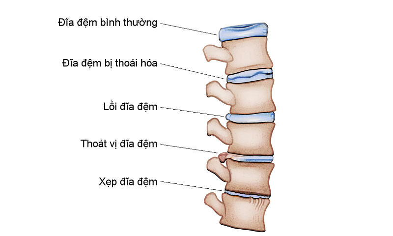 Lồi đĩa đệm là tình trạng bao xơ đĩa đệm bị tổn thương