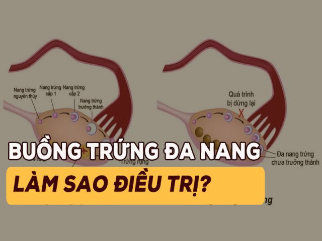 Buồng trứng đa nang muốn có con, tránh biến chứng không nên bỏ qua những thông tin này