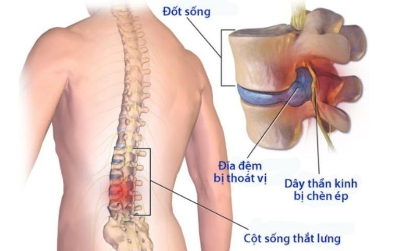 Thoát vị đĩa đệm tiến triển qua nhiều giai đoạn