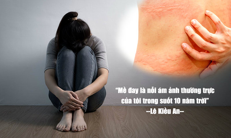 Mề đay mãn tính là bệnh lý dai dẳng, phiền toái, gây ám ảnh cho chị An