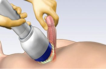 Tổng hợp những cách chữa liệt dương hiệu quả nhất bạn nên biết