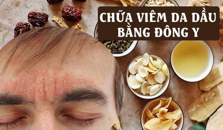 Chữa viêm da dầu bằng đông y và những điều cần lưu ý