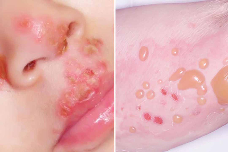 Pemphigus là một dạng bệnh tự miễn có mức độ nặng, nguy cơ tử vong cao