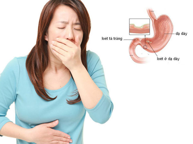 Đau dạ dày buồn nôn là hiện tượng phổ biến hay gặp