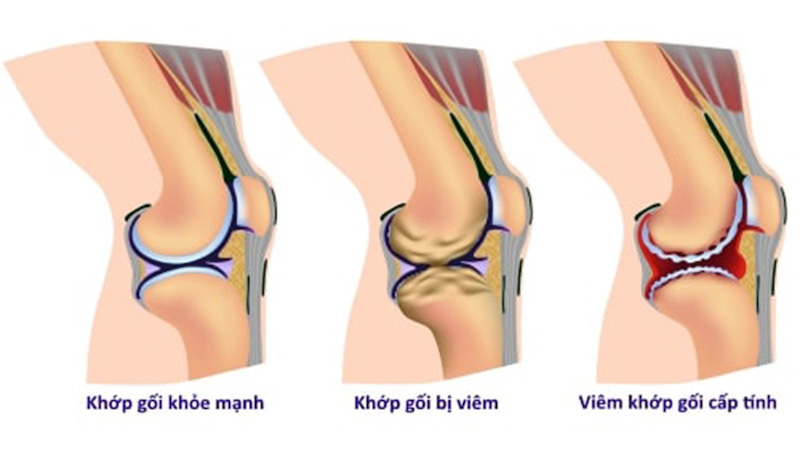 Viêm khớp cấp và mãn tính gây đau khớp gối