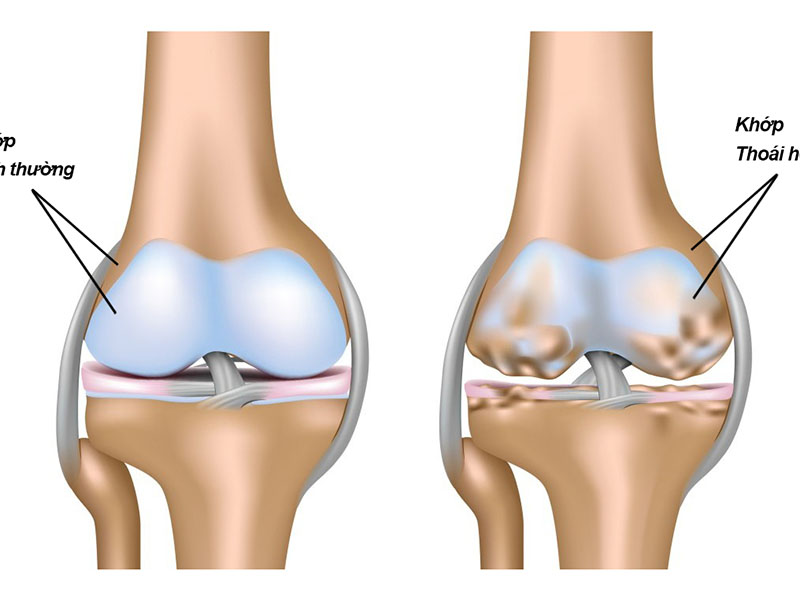 Đau khớp gối khi chạy bộ có thể do thoái hóa khớp