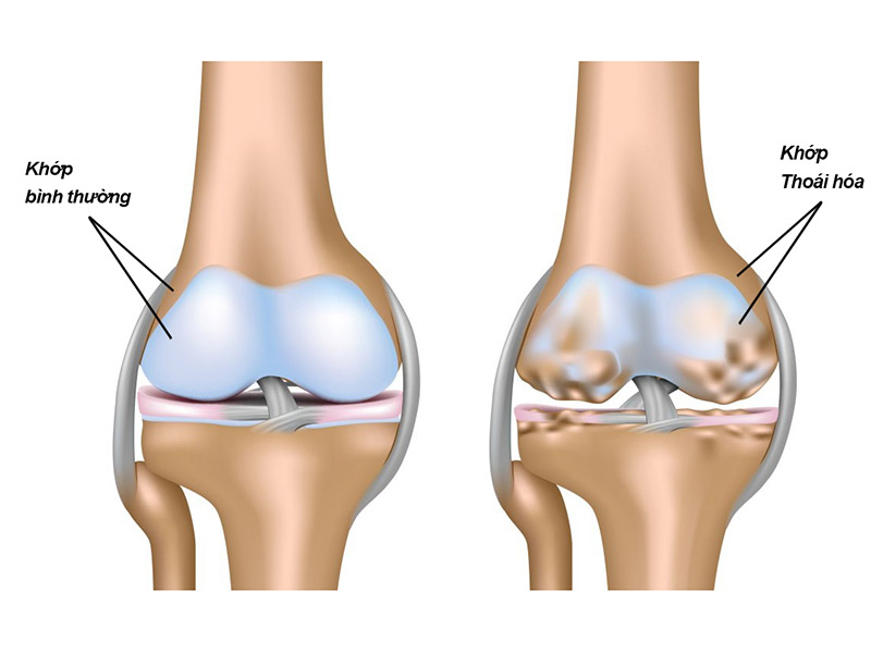 Đau khớp gối khi đứng lên ngồi xuống là dấu hiệu bệnh lý thoái hóa khớp
