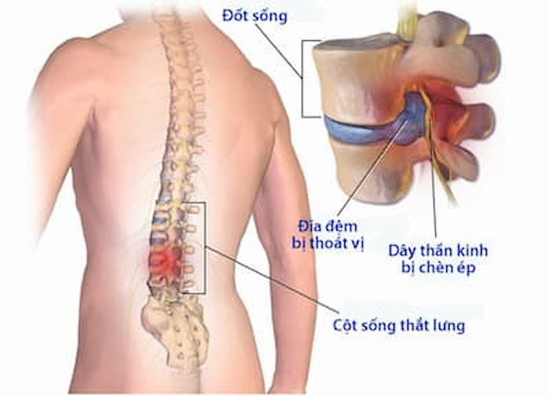 Điều trị thoát vị đĩa đệm tại nhà