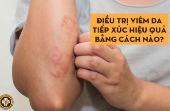 Chữa viêm da tiếp xúc hiệu quả bằng cách nào?