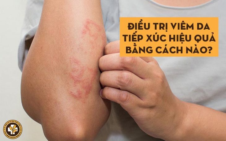 Chữa viêm da tiếp xúc hiệu quả bằng cách nào?