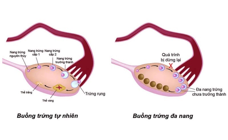 Hình ảnh buồng trứng đa nang