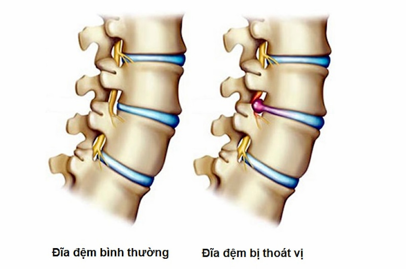 Mổ thoát vị đĩa đệm giải quyết những cơn đau do dây thần kinh bị chèn ép