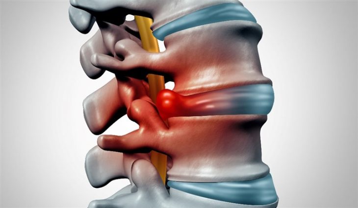 Phồng đĩa đệm L4 - L5 ở vị trí cột sống thắt lưng