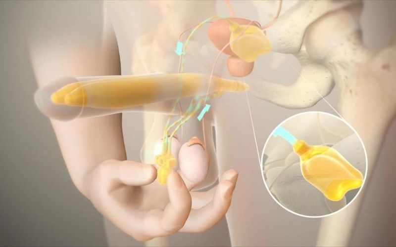 Các liệu pháp bơm chân không được áp dụng cho nam giới rối loạn cương dương