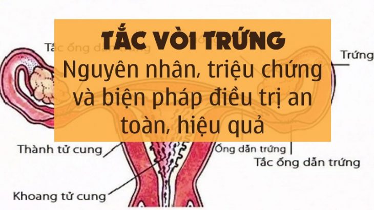 Tắc vòi trứng ở nữ giới