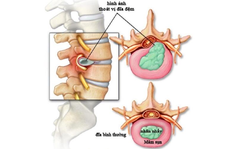 Thoát vị đĩa đệm cổ là hiện tượng nhân nhầy đĩa đệm cột sống cổ tràn ra ngoài