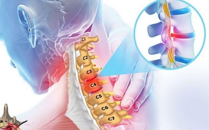 Thoát vị đĩa đệm đốt sống cổ C3 C4 là ở đâu? Điều trị thế nào?